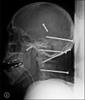 nail-head-xray.jpg
